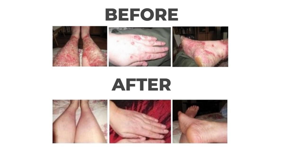 Before and After Psoriasis