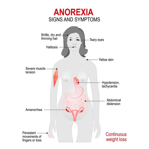 A woman silhouette with highlighted internal organs showing signs and symptoms of Anorexia Nervosa