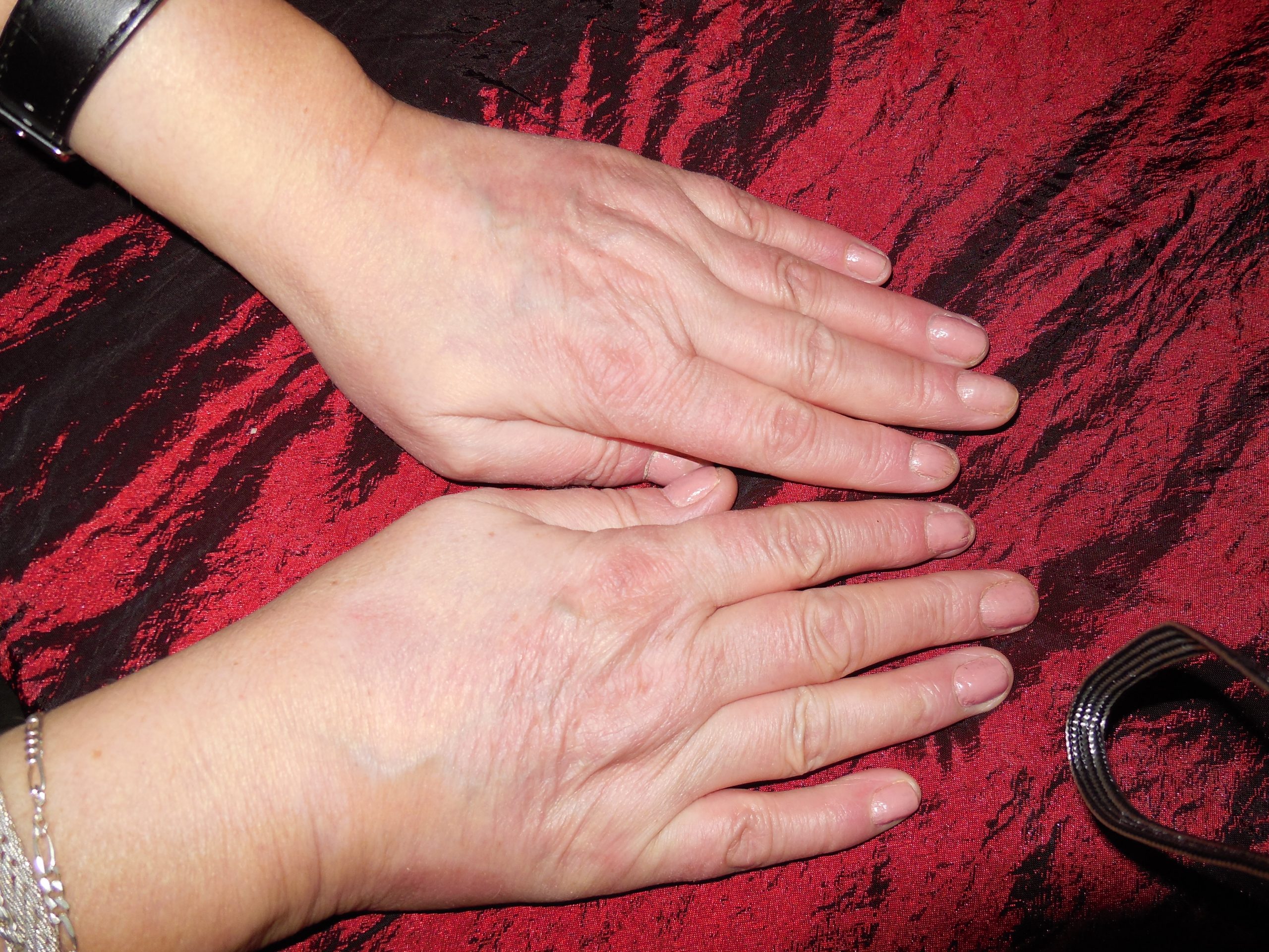 Woman's Healed hands after suffering from Psoriasis