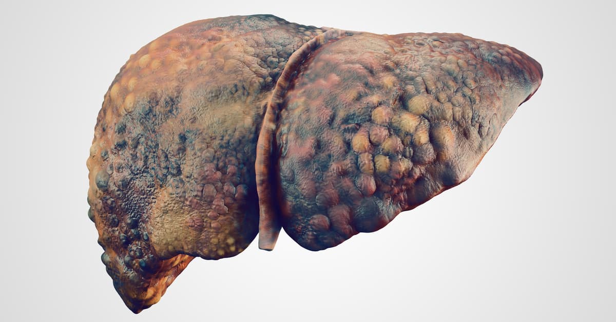 A liver that has been damaged due to choline deficiency