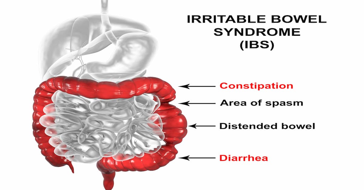 3D illustration showing symptoms of IBS in the of large intestine
